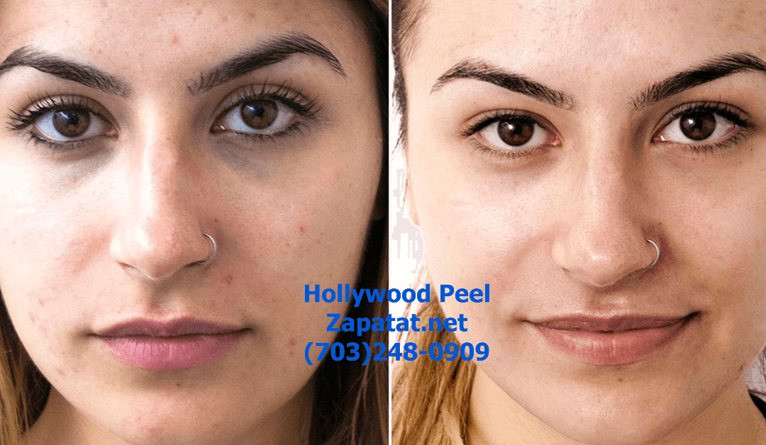 Hollywood Carbon Peel vs. Hollywood Facial: Which is Right for You?