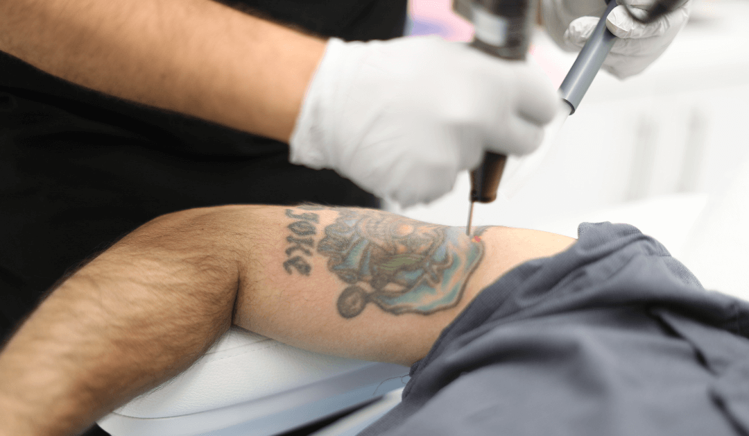Zapatat’s Ultimate Tattoo Removal Aftercare Guide