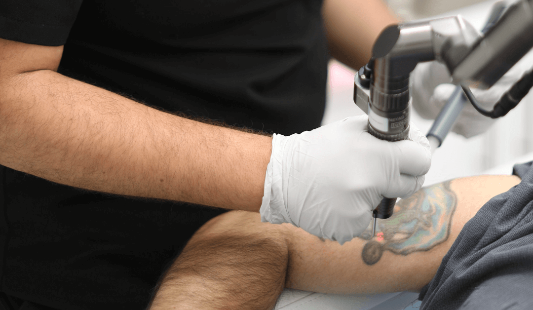 The Impact of Tattoo Colors on the Removal Process
