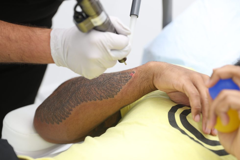 What You Need To Know About Saline Tattoo Removal