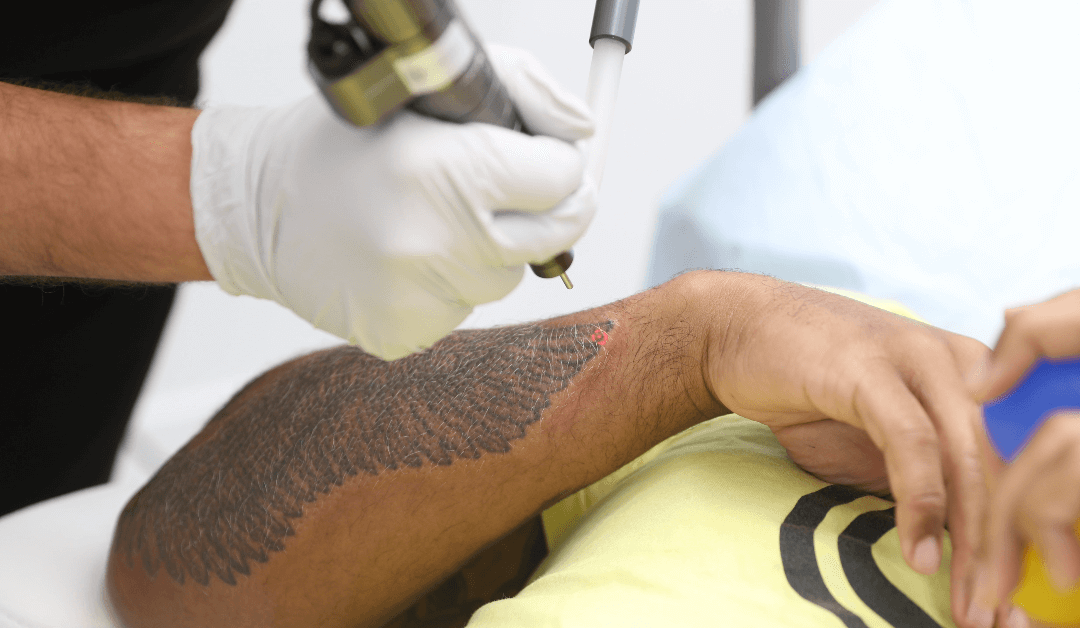 Secrets of Fastest Tattoo Removal: Effective Techniques and Insights