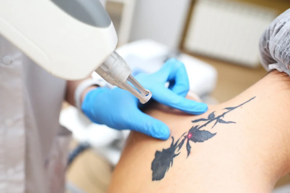 Tattoo Removal Packages: The Dirty Secrets