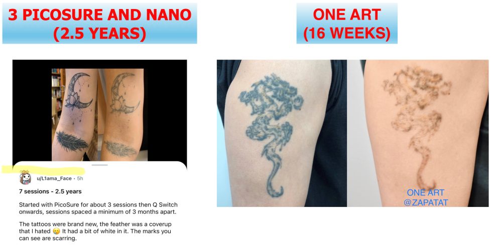 Why Zapatat®️ doesn’t use “Pico” lasers for Tattoo Removal?!