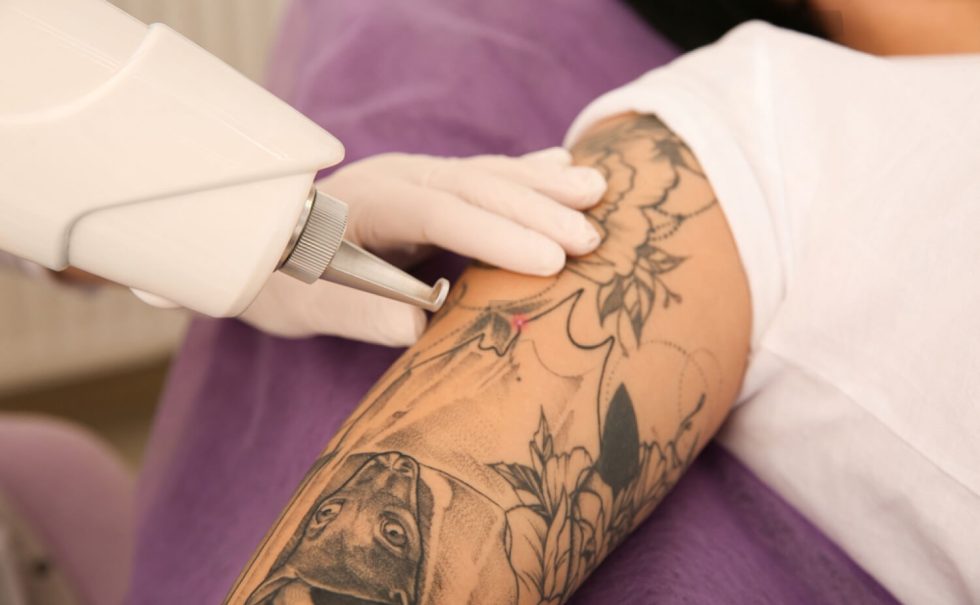 Can Laser Tattoo Removal Be Done While Waiting for Enlistment?